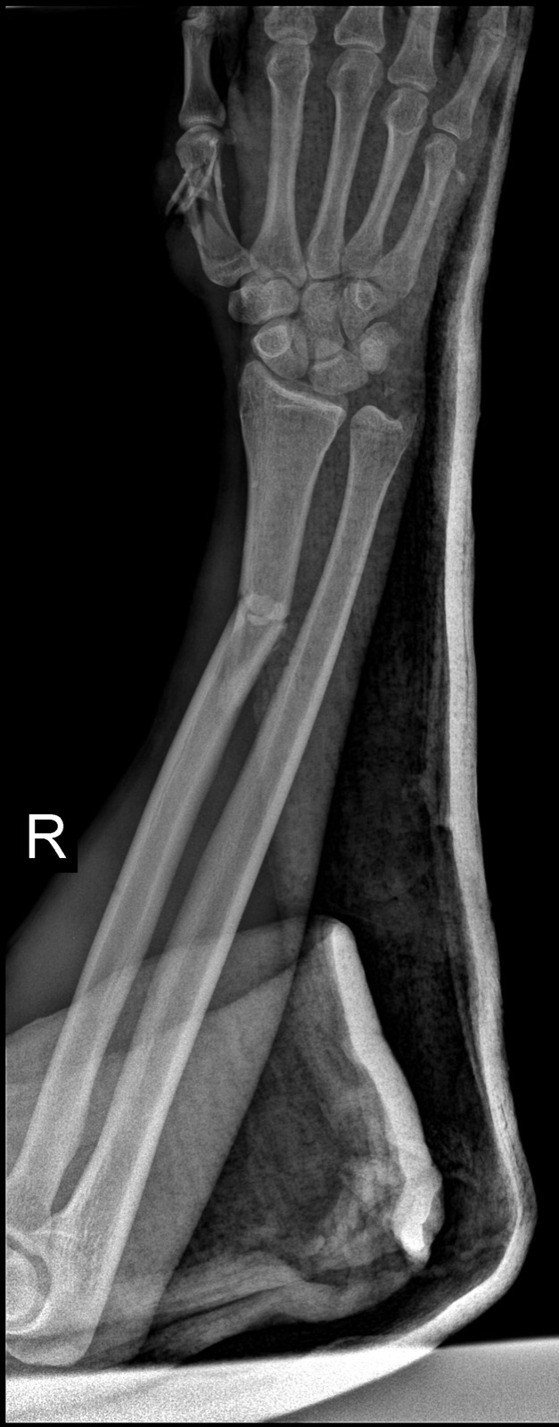 X-ray of the wrist and forearm showing an orthopedic trauma case
