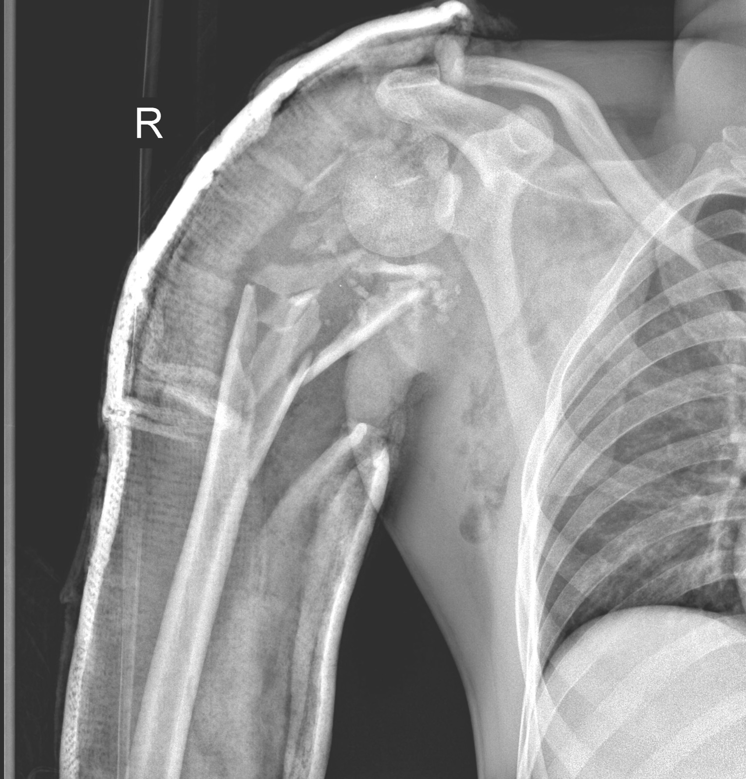 X-ray of a shoulder joint replacement implant
