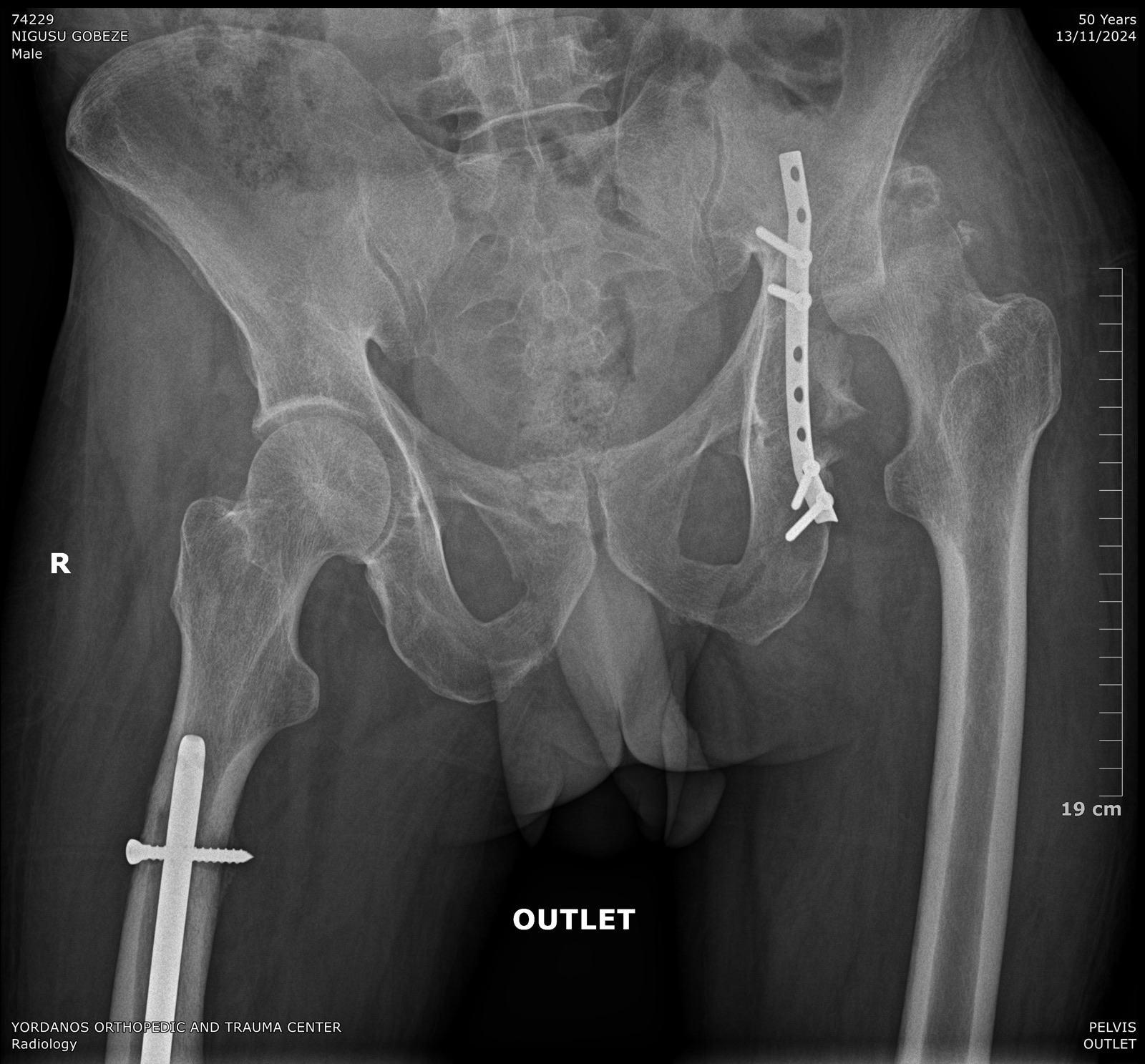 X-ray of a pelvic reconstruction plate following complex trauma
