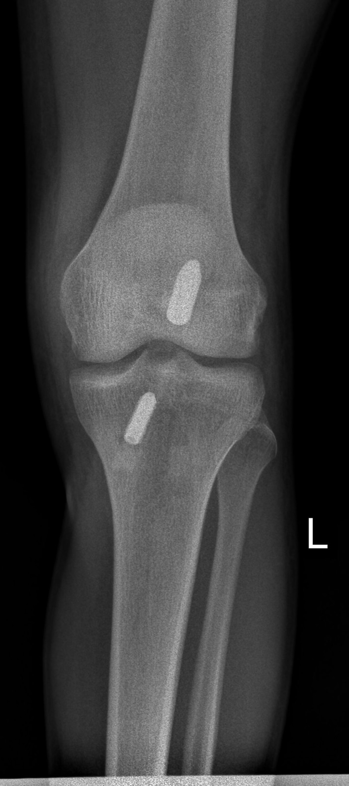 Knee joint X-ray after ACL reconstruction surgery showing fixation hardware